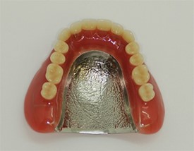 金属床義歯（総義歯）