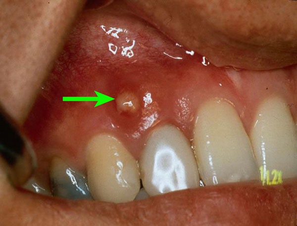 歯茎 の 嚢胞