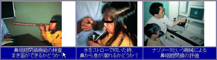 口蓋裂言語治療のイメージ