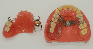 金属床義歯（局部義歯）