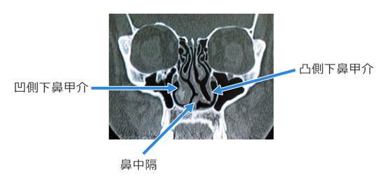 CT検査結果