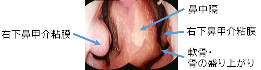 鼻内所見