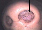 鼻入口部まである病変