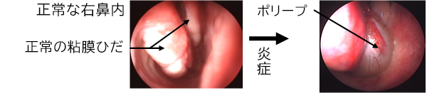 鼻茸とは