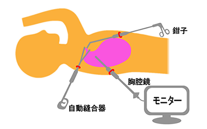 胸腔鏡下手術とは