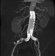 腹部ステント画像