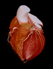 冠動脈（心臓血管）　3D画像