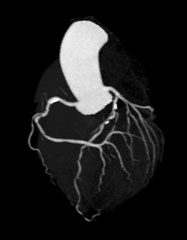 冠動脈（心臓血管）　MIP画像
