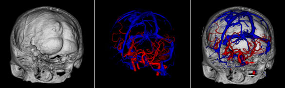 脳３Ｄ－ＣＴ Angiography画像