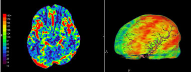 脳CT-Perfusion(CTP)画像