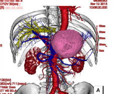 腹部3Ｄ画像（ＣＴＡ）