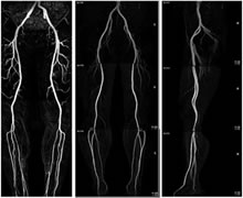 下肢動脈（造影）