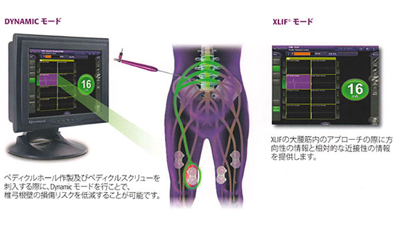 Nuvasive社製Nurovision M5システム