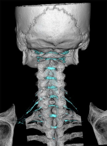 首の骨と神経を3Dで表示