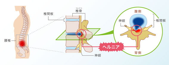 腰椎椎間板ヘルニアとは