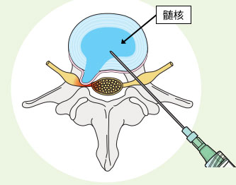 椎間板内酵素注入療法（ヘルニコア治療）について