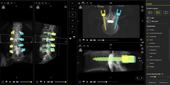 【図4】 MAZOR Xのプラニングソフト（UNiD ロッド適応前）