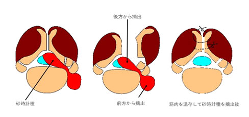 筋温存型脊髄腫瘍摘出術