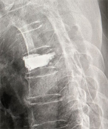 当院で施行した第６胸椎圧迫骨折例