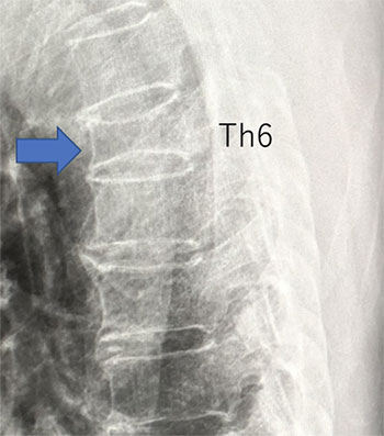 当院で施行した第６胸椎圧迫骨折例