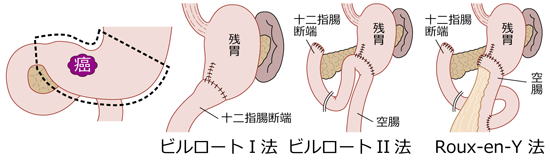 胃再建