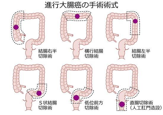 大腸癌