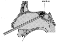 手術方法