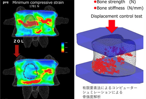 有限要素法によるコンピューターシミュレーションによる骨強度解析