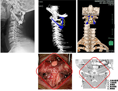 環軸椎亜脱臼に対する、顕微鏡下筋肉温存固定術