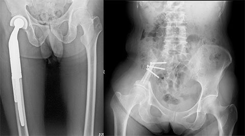 肺癌大腿骨近位骨腫瘍に対する広範切除、腫瘍用人工骨頭置換（左）<br>
								骨盤悪性骨腫瘍に対する広範切除、再建術（右） 