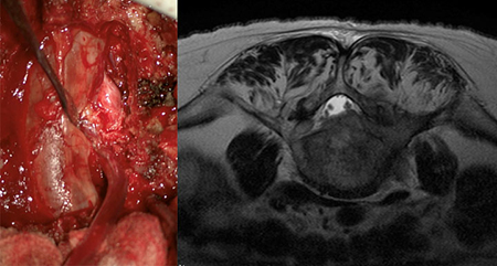 顕微鏡を使用した転移性脊椎腫瘍の治療