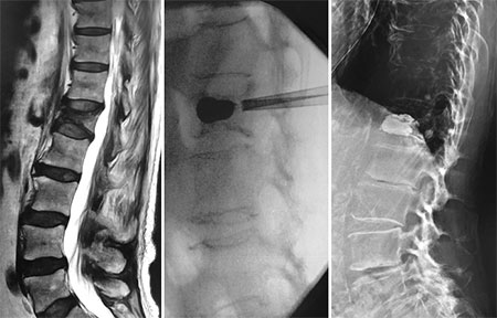 L1圧迫骨折に対する、経皮的椎体形成