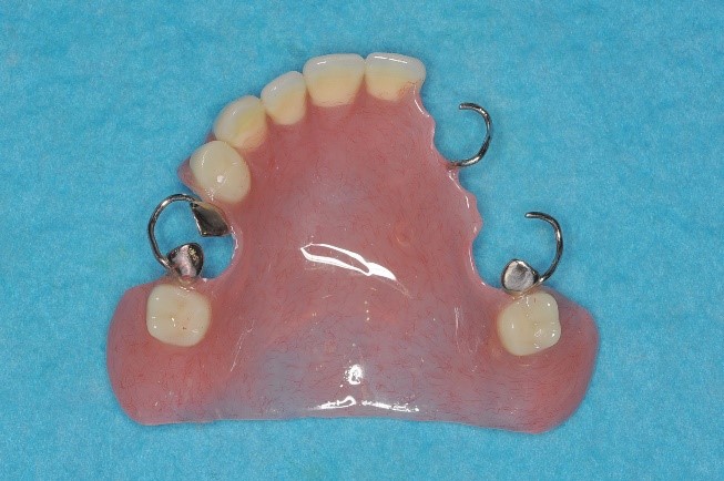 レジン床義歯１