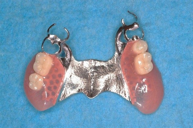 金属床義歯（部分床義歯）１