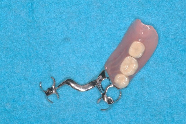 金属床義歯（部分床義歯）２