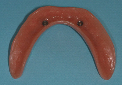 インプラント上義歯（義歯に加工）