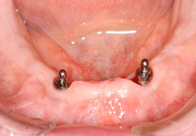 インプラント上義歯（お口に植立）