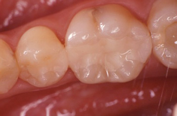 虫歯の治療 症例１イメージ2