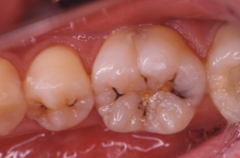 虫歯の治療 症例１イメージ1
