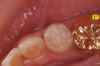 虫歯の治療 症例2イメージ2