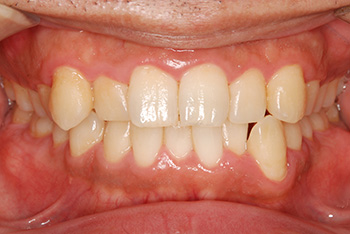 歯周病の治療イメージ2