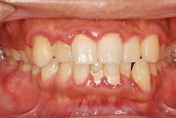 歯周病の治療イメージ1