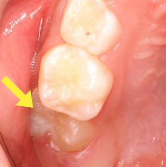 萌出異常（永久歯が乳歯に引っかかっている）01