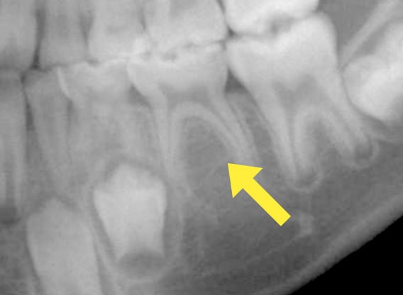 歯の先天性欠如