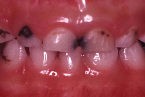 乳歯・永久歯のむし歯治療　治療前