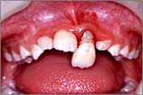 乳歯・永久歯の外傷　受傷時