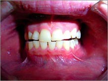 口腔内歯や歯茎イメージ