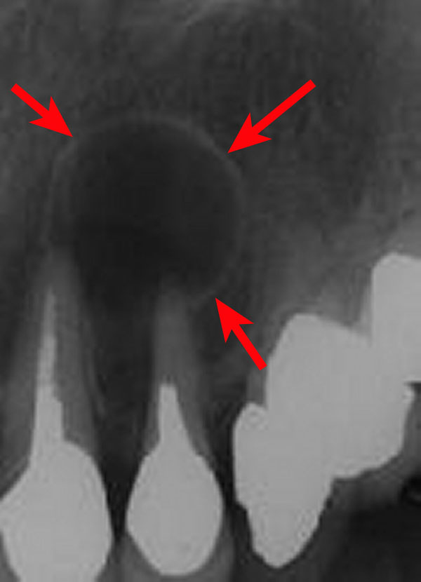 歯根 嚢胞 レントゲン に 映ら ない