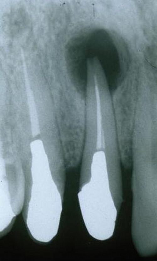 歯根嚢胞に対する歯根端切除術＋嚢胞摘出術01
