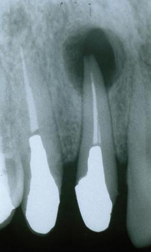 歯根 嚢胞 レントゲン に 映ら ない